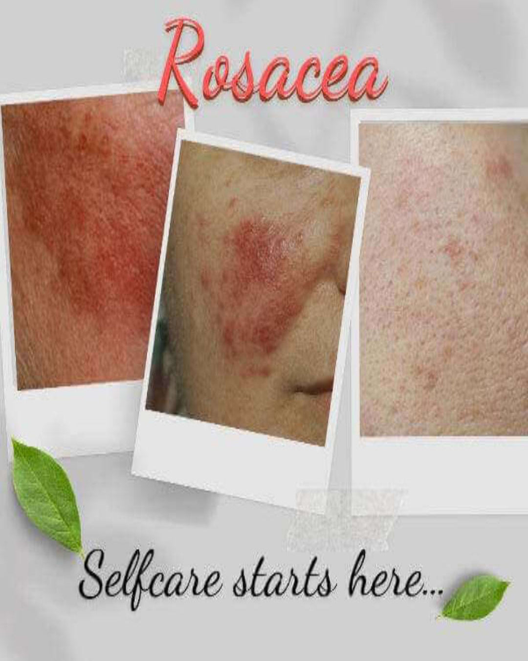Organic Moisturizer for Rosacea Prone Skin - For Women & Men-1