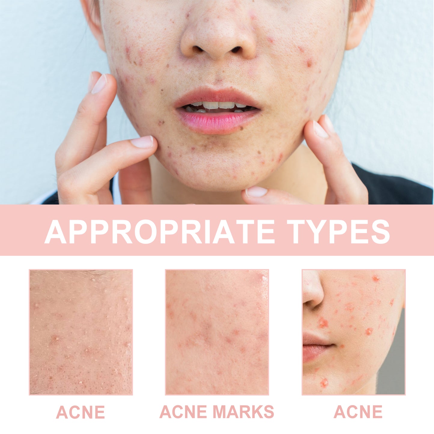 Acne Patch, Repair Acne Pimple Facial Redness Clean Pores Moisturize Skin Patch