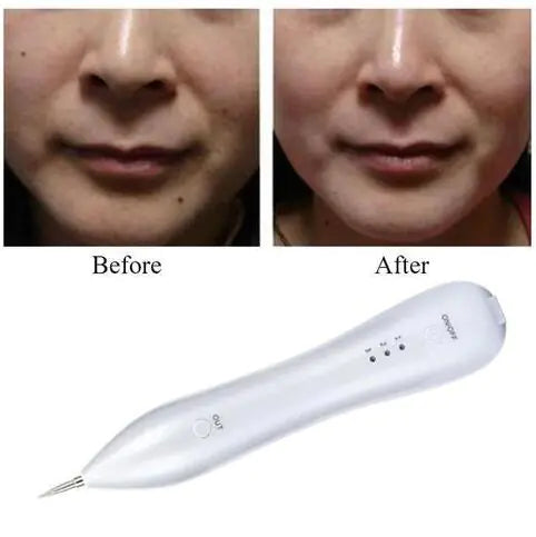 Mole Removal Beauty Device