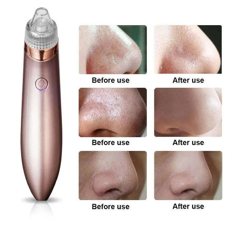 Rose Gold Electric Blackhead Vacuum with Strong Suction